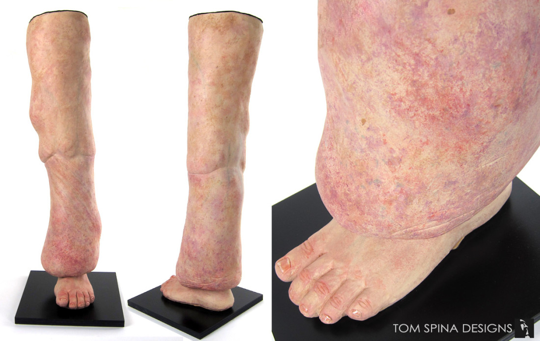 anatomical leg model with lymphedema