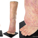 anatomical leg model with lymphedema